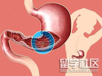 胃穿孔最多见于胃溃疡,是溃疡病最严重的并发症,是普通外科最常见